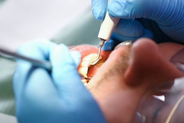 Best Emergency Tooth Extraction in Reading, OH
