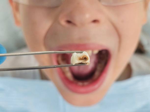 Best Urgent Care for Lost Fillings or Crowns in Reading, OH